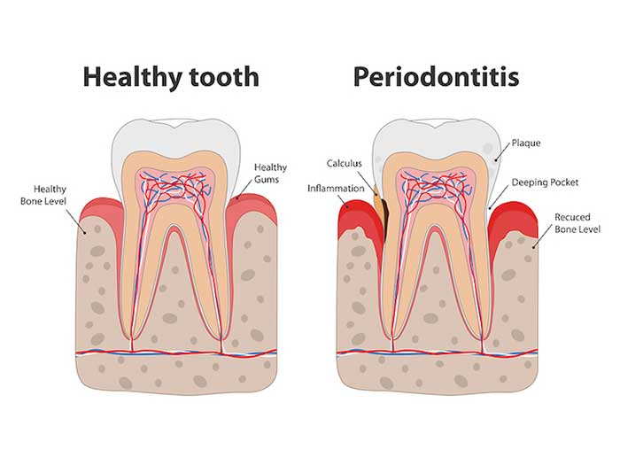 Image of a healthy tooth and periodontitis tooth