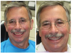 Before and after image of a man doing dental implant