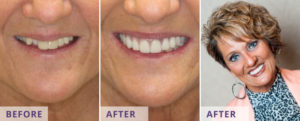 Image of a woman before and after dental implant