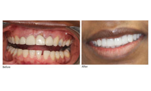 Before and after image of teeth