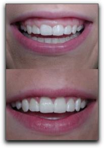 Before and after image of crown lengthening
