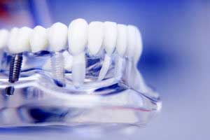 Photo of dental implant