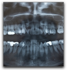 X-ray of teeth